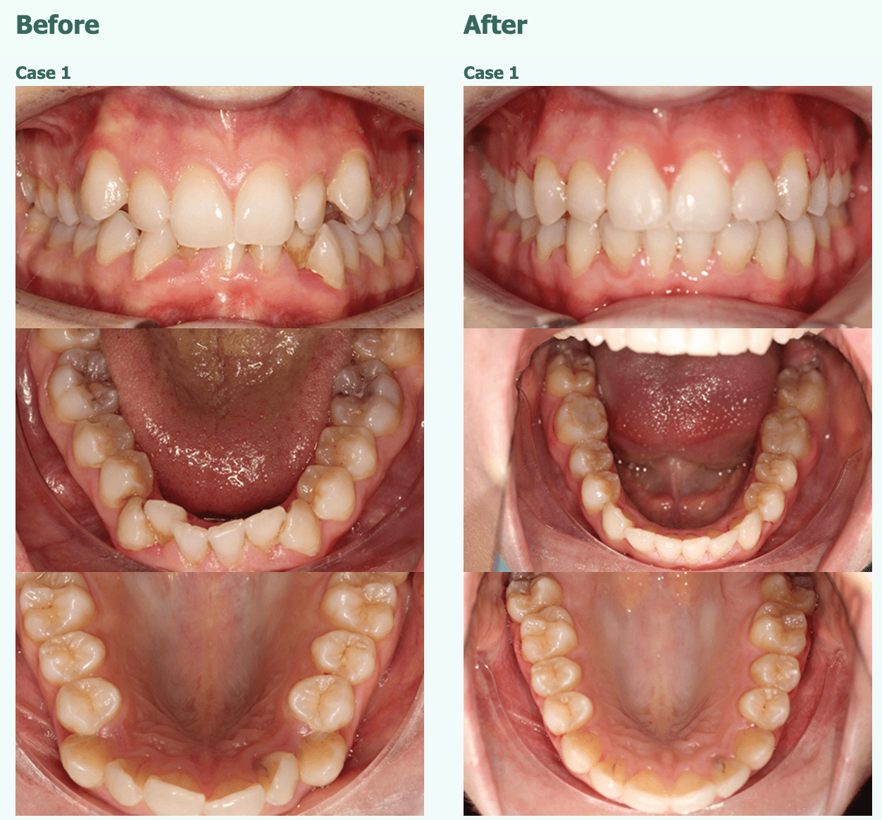 Teeth Straight Case 1