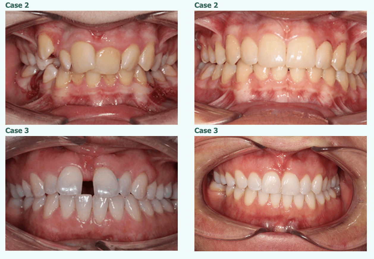Teeth Straight Case 2