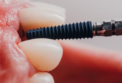 Understanding Osseointegration and Implant Stability