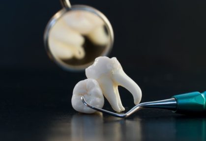 What to Expect During a Wisdom Tooth Removal Consultation with Dr Omesh Modgill