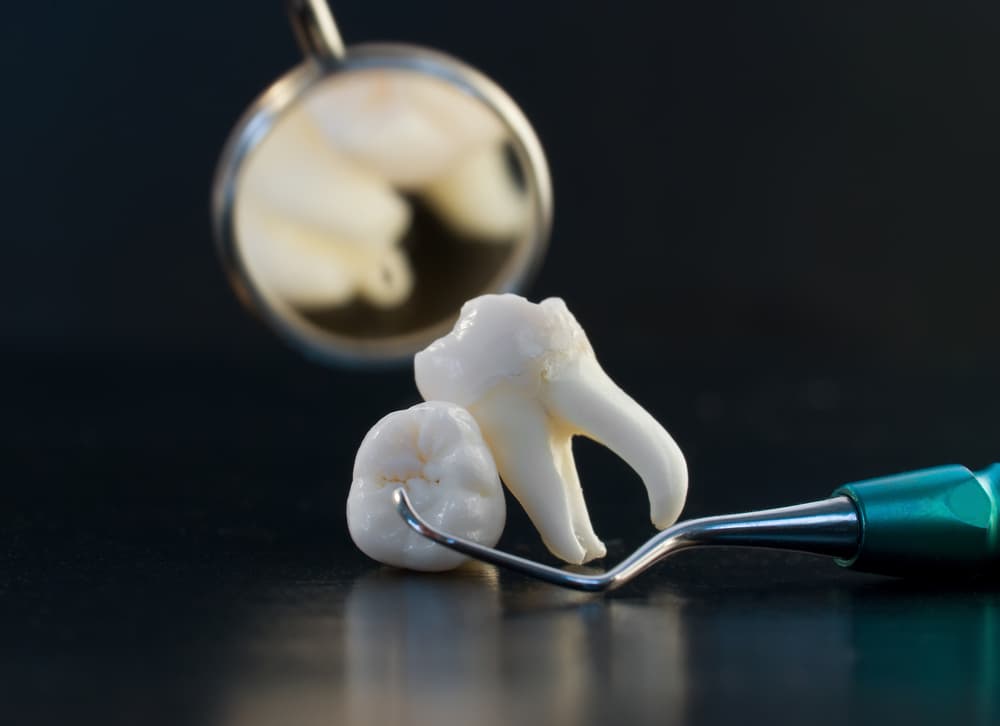 Wisdom Tooth Removal