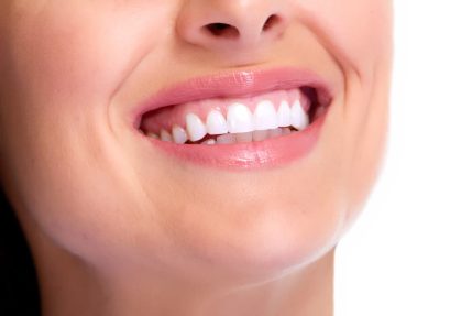 What to Expect After Getting Veneers