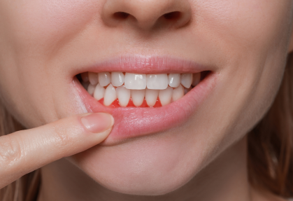 Why Your Gums Are Bleeding — And Why You Should Never Ignore It