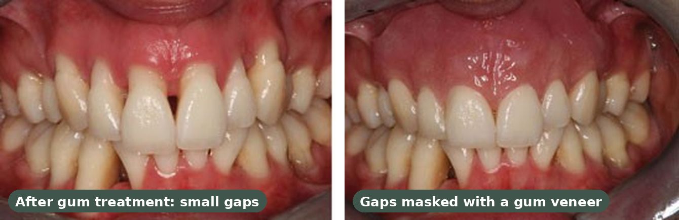 After gum treatment, small gaps between the teeth, then the same smile with the gaps masked by a gum veneer