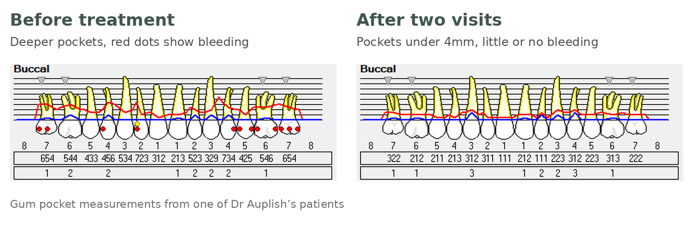 Gum pocket chart before and after treatment, showing shallower pockets and less bleeding