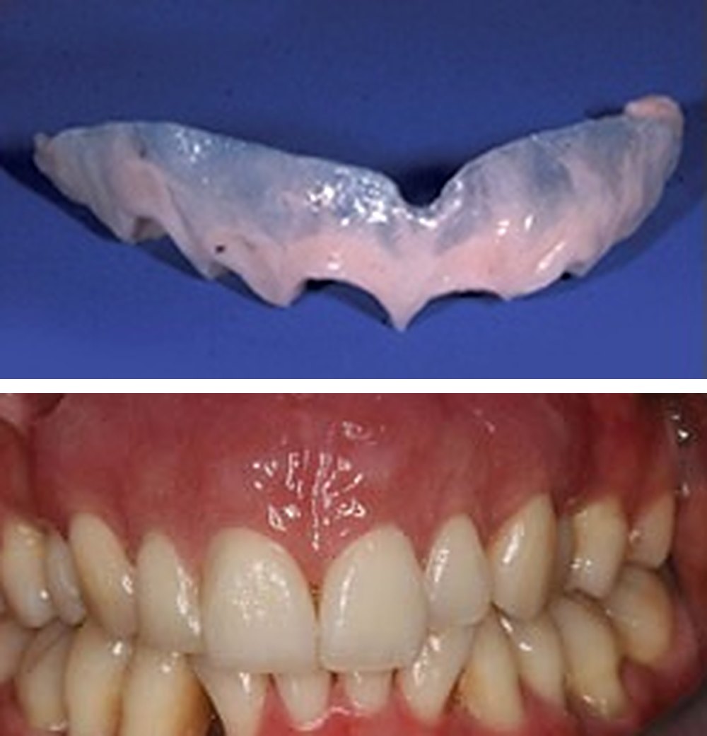 Removable gum veneer, and the gum veneer in place over the upper teeth