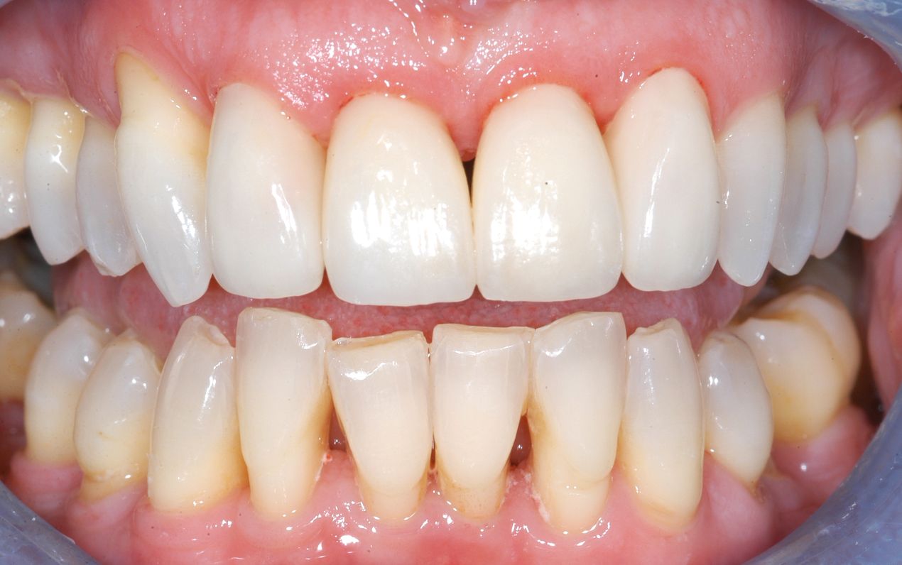 Natural-looking smile after recession was masked with veneers